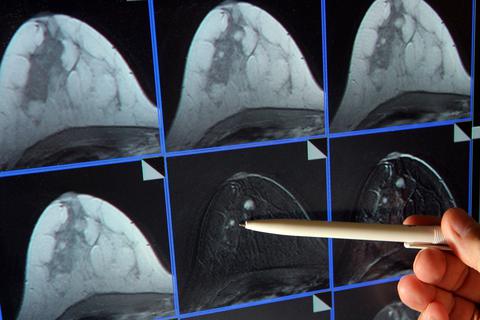 Auf der Bildschirmdarstellung einer Magnetresonanz-(MR)-Mammographie ist ein winziger Tumor in der Brust einer Patientin zu sehen (Symbolbild). Eine Krebsdiagnose ist belastend. Eine Patientin aus dem Hinterland kritisiert die lange Wartezeit auf Arzttermine.